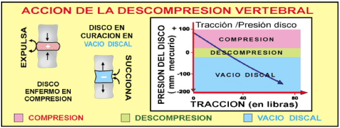 1-1 Descompresión Axial vs Tracción
