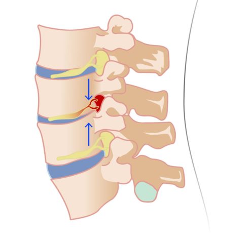 IMAGEN-1 PATOLOGÍAS ASOCIADAS AL DOLOR LUMBAR