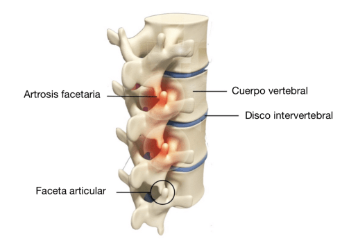 IMAGEN-2 PATOLOGÍAS ASOCIADAS AL DOLOR LUMBAR