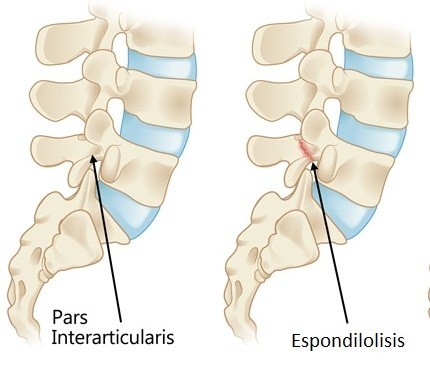 IMAGEN-4 PATOLOGÍAS ASOCIADAS AL DOLOR LUMBAR