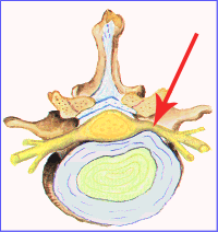 IMAGEN-5 PATOLOGÍAS ASOCIADAS AL DOLOR LUMBAR