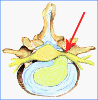 IMAGEN-6 PATOLOGÍAS ASOCIADAS AL DOLOR LUMBAR