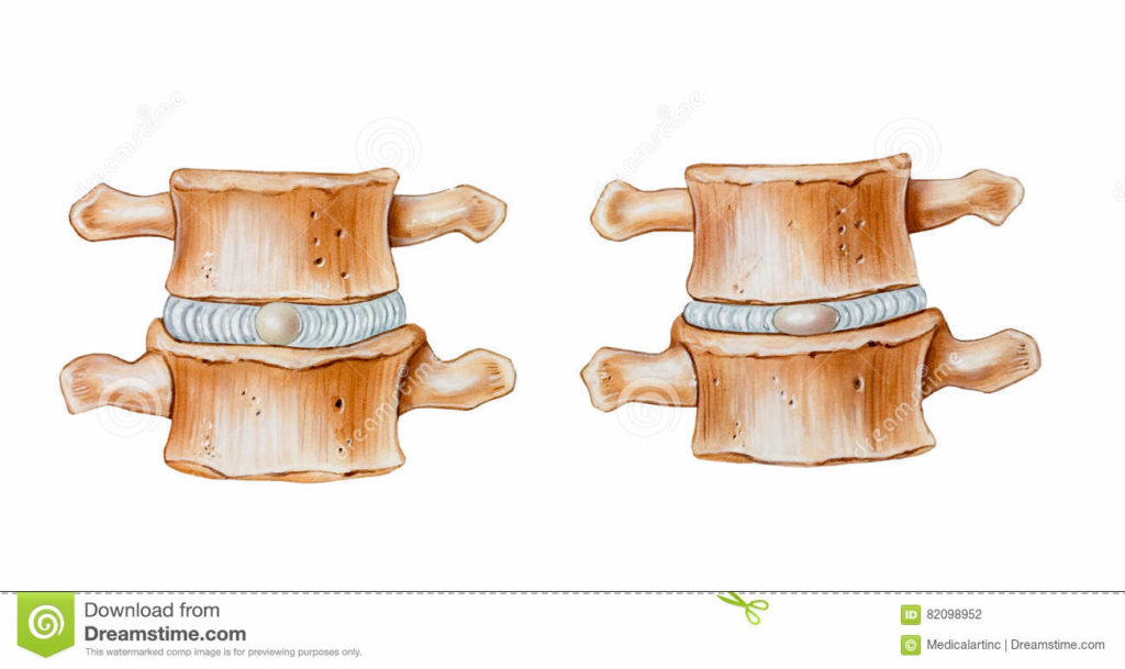 hidratación-discal-2-1024x609 HIDRATACIÓN DEL DISCO INTERVERTEBRAL Y SU RELACIÓN CON LAS HERNIAS